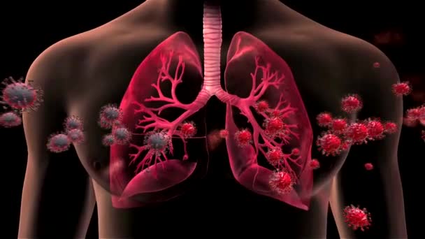 Zakażenie płuc. Realistyczna animacja 3D materiału filmowego ostrego zespołu oddechowego koronawirusa 2 (SARS-CoV-2) znanego jako 2019-nCoV. Powieść Koronawirus zbliżenia.Wysokiej jakości animacja medyczna. - Materiał filmowy, wideo