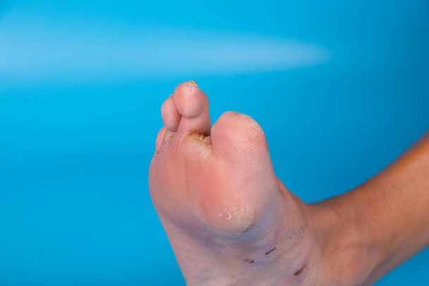 Cukorbeteg lábujjak amputálása kék hátterű személynél. Szelektív fókusz. - Fotó, kép