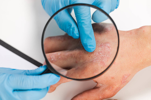 Дерматолог в перчатках осматривает кожу больного пациента. Обследование и диагностика кожных заболеваний - аллергии, псориаза, экземы, дерматита. - Фото, изображение
