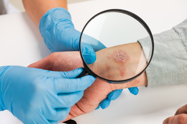 Un dermatólogo que usa guantes examina la piel de un paciente enfermo. Examen y diagnóstico de enfermedades de la piel-alergias, psoriasis, eczema, dermatitis. - Foto, Imagen