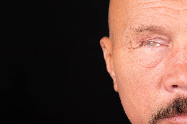 Close-up of a man's face with the consequences of glaucoma, dry eyes. Selective focus. - Фото, зображення