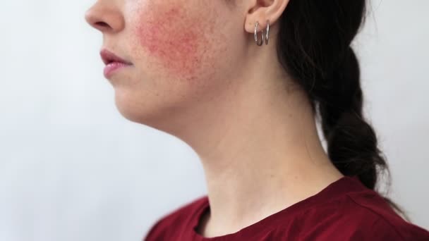 Portrait in profile close-up of a young woman with a large redness on her cheek. White background. The concept of rosacea and couperose - Footage, Video