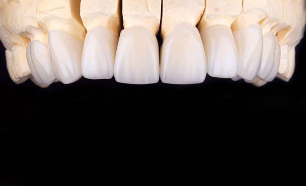 Στόμα γεμάτο δόντια από ζιρκόνιο αψίδα κεραμικά κορώνες ανθρώπινα δόντια της άνω καπλαμάδες των δοντιών πρόθεση. Οδοντιατρική κλινική αποκατάστασης ασθενή. Εμφυτεύματα σε μαύρο φόντο closeup χειρουργική επέμβαση dentistryV - Φωτογραφία, εικόνα