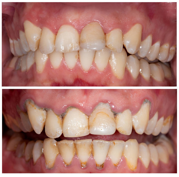 Perfect smile before and after bleaching procedure whitening of zircon arch ceramic prothesis Implants crowns. Dental restoration treatment clinic patient. Result of oral surgery dentistry, - Photo, Image
