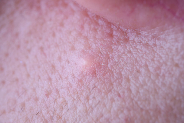 Zánětlivé onemocnění kůže obličeje dospívajícího akné makro detailní - Fotografie, Obrázek