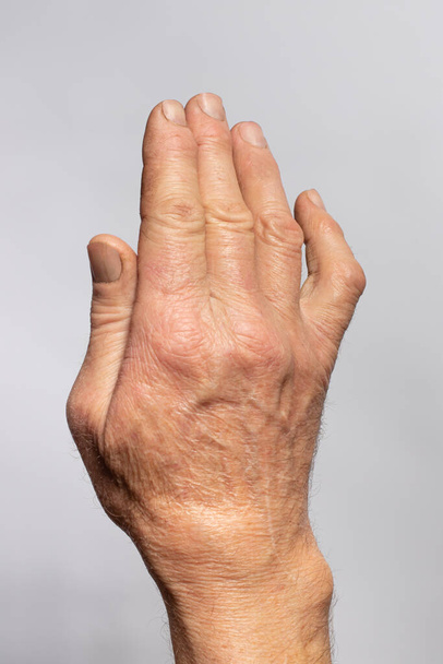 Ένα ανθρώπινο χέρι βούρτσα σε ένα γκρι φόντο με θέση για κείμενο για την ιατρική και την τραυματολογία. Αγκύλωση από κοινού φάλαγγα του μικρού δακτύλου 5 δάχτυλα, ακινησία των αρθρώσεων, οστεοαρθρίτιδα και αρθρίτιδα. - Φωτογραφία, εικόνα