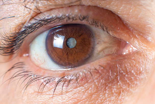 Makroaufnahmen des menschlichen Auges - Trübung der Linse durch Katarakt, Verschlechterung des Sehvermögens. Kataraktbehandlung, Chirurgie und Augenheilkunde - Foto, Bild