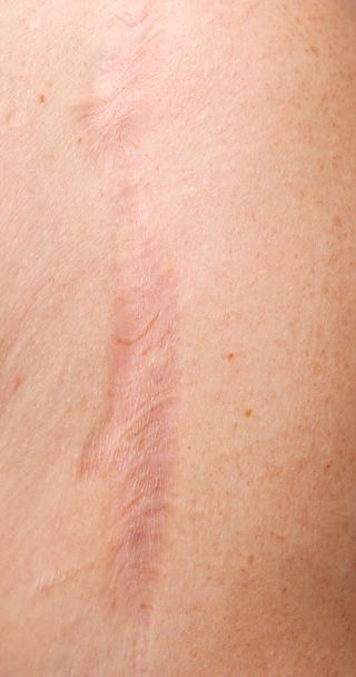 cicatriz de piel
 - Foto, Imagen