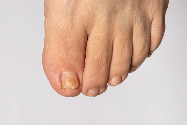 El hongo de las uñas en el dedo gordo del pie - dermatomicosis y onicomicosis, infección por hongos macro foto. - Foto, imagen