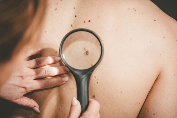 Dermatolog vyšetřující kůži na zádech pacienta - Fotografie, Obrázek