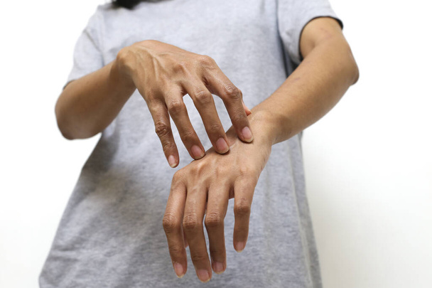 アレルギーよ。かゆい肌。女性の手は白地に傷を負っている - 写真・画像