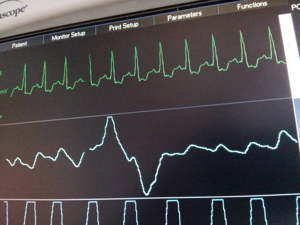 EKG, pulso y respiración Pantalla del monitor de la UCI - Foto, imagen