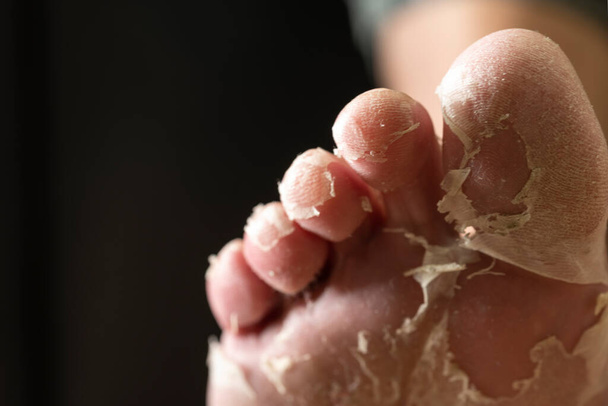 Gros plan du pied étiré affichant une peau mal exfoliante - Photo, image