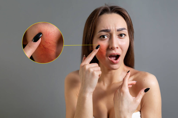 Il concetto di rosacea. Una donna caucasica bruna punta un dito contro una guancia rossa con l'infiammazione. Ricevuto. Zoom cerchio mostra problemi di pelle. Fondo grigio. - Foto, immagini