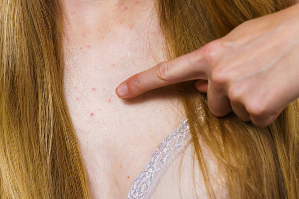 Health problem, skin diseases. Young woman showing her neckline with acne, red spots. Female with pimples. - Fotó, kép