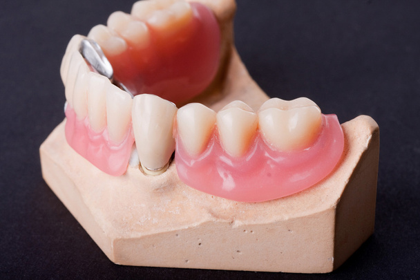Modèle de cire dentaire
 - Photo, image