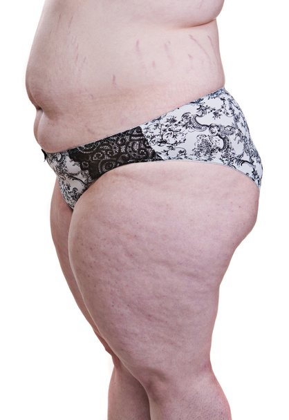 Detail of the side torso girl with obesity and cellulite  - Φωτογραφία, εικόνα