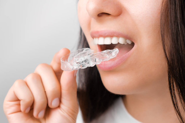 Close up de uma jovem mulher ajustando alinhadores transparentes. A tratar dos dentes. Tratamento ortodôntico para alisamento e clareamento dos dentes.  - Foto, Imagem