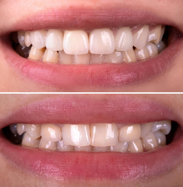 Sorriso perfeito antes e depois branqueamento procedimento de zircão arco prótese cerâmica Implantes coroas. Paciente de clínica de tratamento de restauração dentária. Resultado da cirurgia oral odontologia, - Foto, Imagem