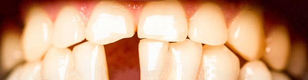Żółte zepsute zęby. Żółte zęby. Kiepski stan zębów, brak zębów, fluoru, nadżerki zębów. Człowiek bez jednego przedniego zęba. Żadnych zębów. Uśmiechnijcie się ludzie z utraconym przednim zębem, ból zęba - Zdjęcie, obraz