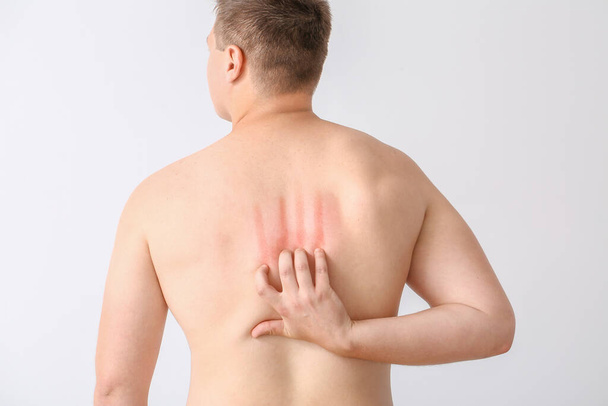 Giovane uomo allergico graffiare la pelle contro sfondo luce - Foto, immagini