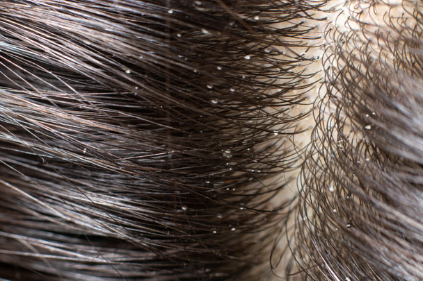 Macro photo dander on dark brunette hair. The problem of dried scalp, wrong shampoo, fungus on the head - Photo, Image