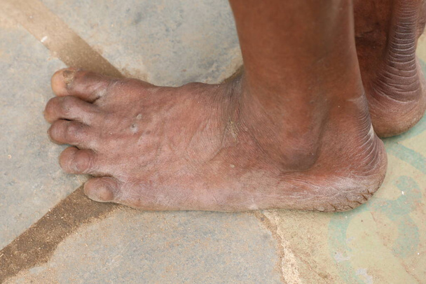 Indian Farmer Damaged Fingers skin disease - Zdjęcie, obraz