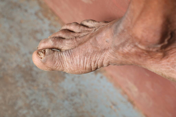 Ινδός αγρότης καταστραφεί Δάχτυλα ασθένεια του δέρματος - Φωτογραφία, εικόνα