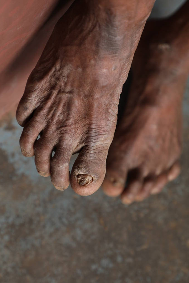 Indiai farmer sérült ujjak bőrbetegség - Fotó, kép
