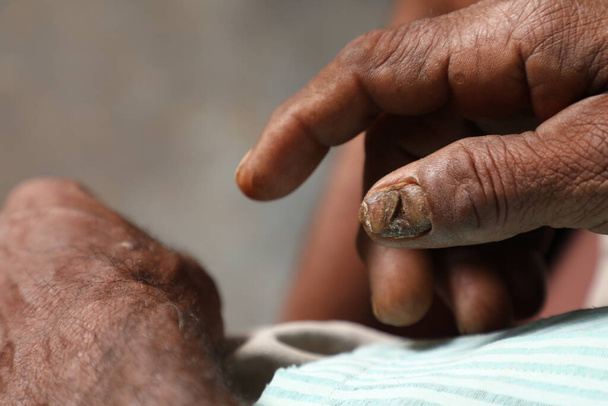 Agricultor indiano Danos Dedos doença de pele - Foto, Imagem
