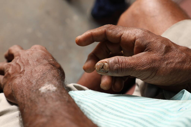 Intialainen viljelijä vaurioitunut sormet - Valokuva, kuva