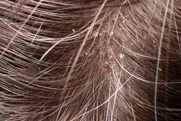 Macro photo of human hair with dandruff. Head wounds and itching, hair care, seborrheic treatment - Photo, Image