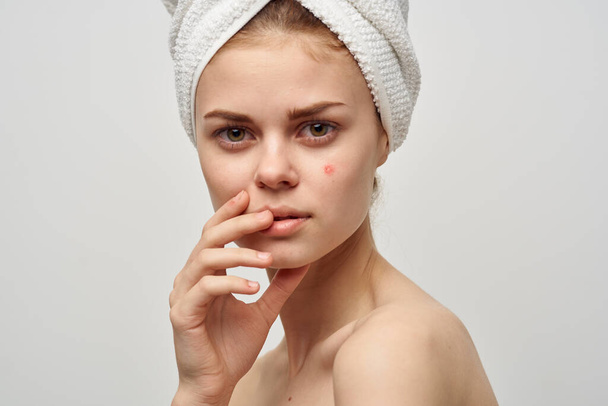 séduisante femme avec serviette sur la tête épaules nues boutons sur le visage soins de la peau acné - Photo, image