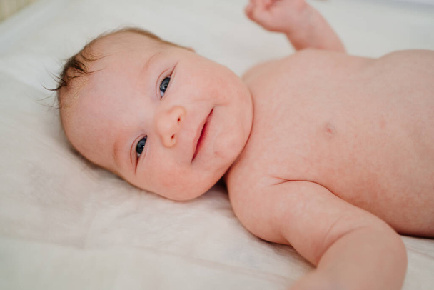 A baby with seborrheic dermatitis on his head rests on a white sheet. childcare. - Photo, Image