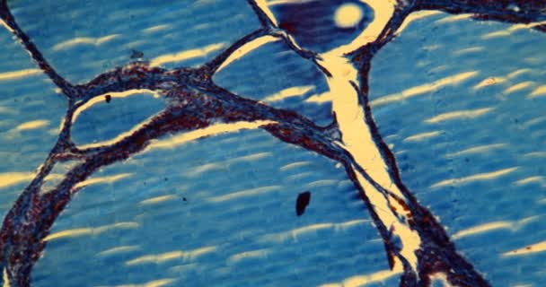 Goitre colloïde tissu goitre sous le microscope 100x - Séquence, vidéo