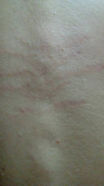 stretch marks on a boys back due to too rapid growth - Photo, Image