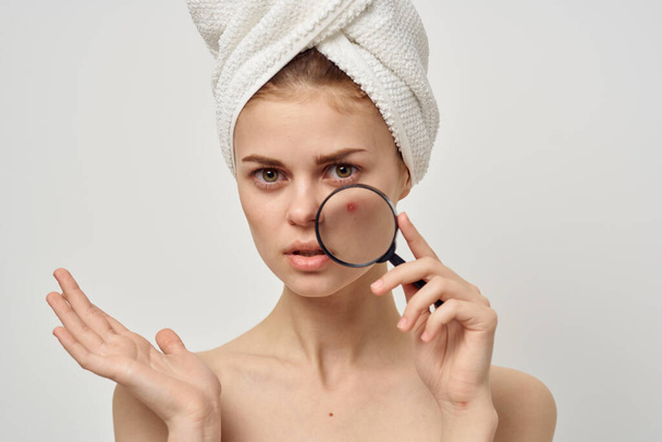 donna con l'acne sul viso tiene una lente d'ingrandimento e sconvolto sguardo asciugamano sulla testa - Foto, immagini