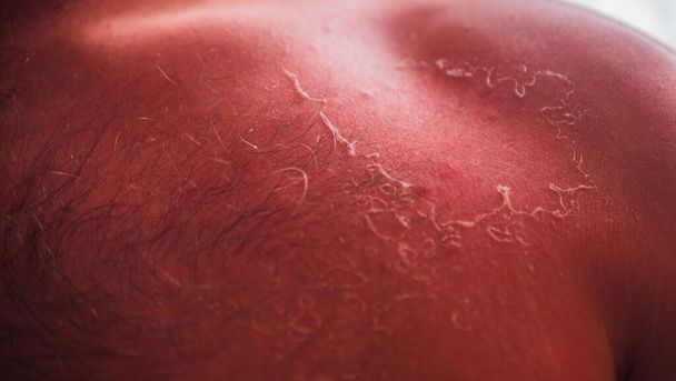 Peeling der Haut auf dem menschlichen Rücken, auch bekannt als Schuppen oder Desquamation nach übermäßigem Kontakt mit der Sommersonne und Sonnenbrand. - Foto, Bild
