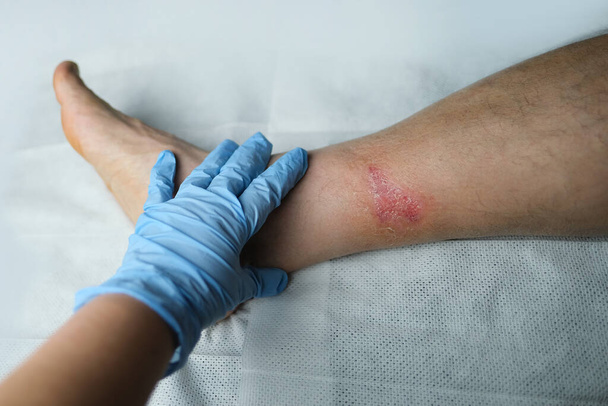 doctor treats a large healing wound from a severe burn on the leg of an adult male patient, redness, scarring of the skin, the concept of medical care, human tissue regeneration - Φωτογραφία, εικόνα