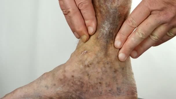 Le mani umane toccano e sbriciolano la gamba macchiata dolorante di persona che soffre di blocco di vene, ulcere, dermatiti, eczemi o altre malattie infettive di dermatologia. Primo piano. - Filmati, video