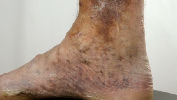 Sore spotty leg of person, suffering from blockage of veins, ulcers, dermatitis, eczema or other infectious diseases of dermatology. Upwards. Close-up. - Footage, Video
