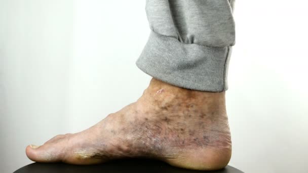 Emberi kéz karcolás fájdalmas foltos láb szenvedő személy elzáródása vénák, fekélyek, dermatitis, ekcéma vagy más fertőző bőrbetegségek. - Felvétel, videó