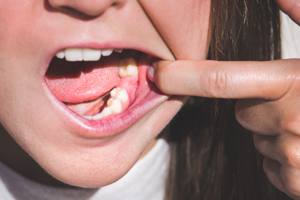 Mujer joven mostrando la boca sin dientes en la mandíbula inferior. Falta un diente. Esperando un implante después de la extracción dental - Foto, Imagen