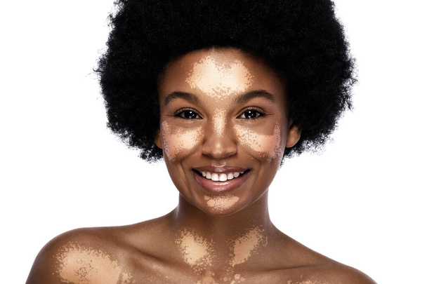 Portrait of young and beautiful black woman with vitiligo skin disorder - Valokuva, kuva