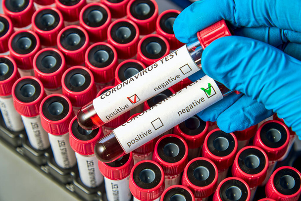 Test tubes in the doctor's hand with blood tests for COVID-19 against the background of vacuum tubes. Blood test for the presence of antibodies to the causative agent of a new coronavirus infection. - Foto, Bild