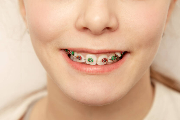 Detailní vícebarevné rovnátka na zubech. Krásný ženský úsměv se samohybnými rovnátky. Ortodontická léčba. stock fotografie - Fotografie, Obrázek