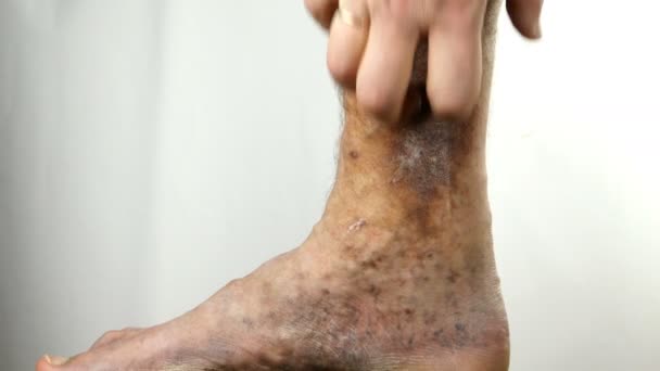 Человеческие руки царапают пятнистую ногу человека, страдающего от закупорки вен, язв, дерматита, экземы или других инфекционных заболеваний дерматологии. - Кадры, видео