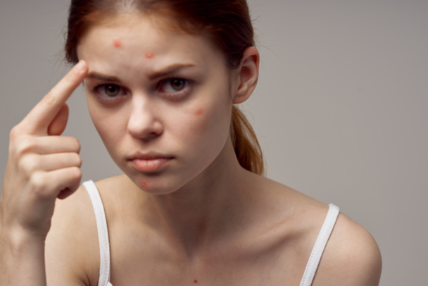 woman with pimple on her face touching face with hands health problems acne - Foto, immagini