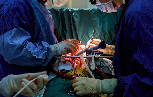 Szívműtét alatti beteg a sebészeti műtőben lévő kórházban - Fotó, kép