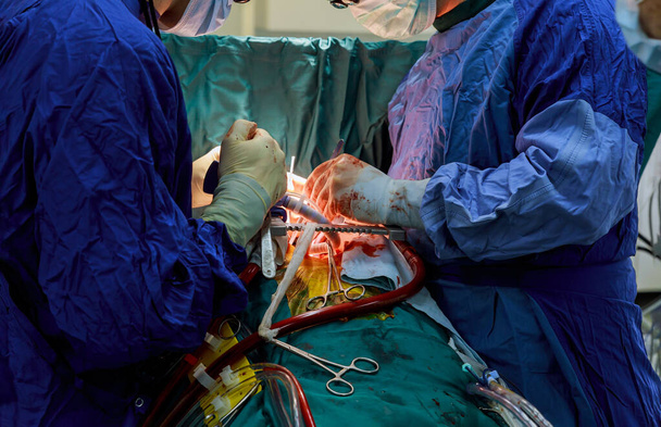 Lääkärit suorittavat leikkaus on mitraaliläpän korvaaminen leikkaus avoimella sydämellä - Valokuva, kuva